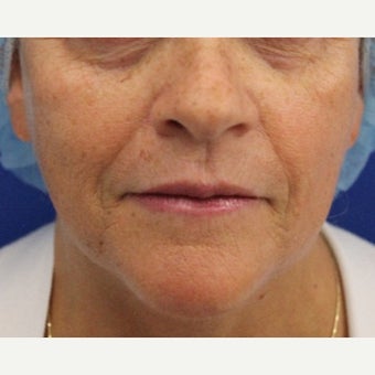 59 year old woman treated with Bellafill for volume loss to mid face before 2120599