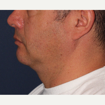 35-44 year old man treated with ThermiTight before 3138907