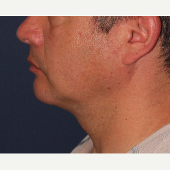 35-44 year old man treated with ThermiTight after 3138907