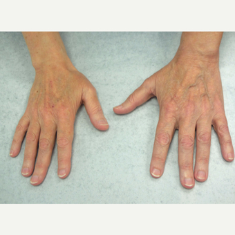 62 year old woman treated with Radiesse for hands before 3140180