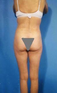 Buttocks Enhancement after 296690
