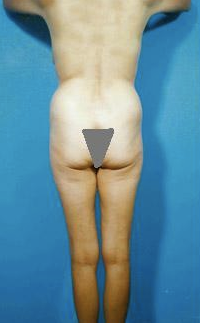 Buttocks Enhancement before 296690