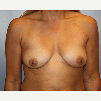 45-54 year old woman treated with Breast Augmentation before 3683516
