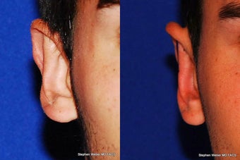 Ear Surgery before 1445767