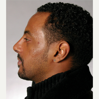 25-34 year old man treated with Rhinoplasty after 3691993