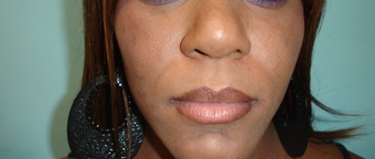 33 year old female treated with African American Rhinoplasty before 957866