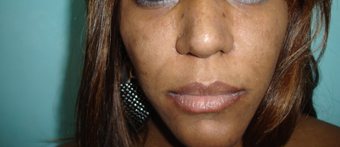 33 year old female treated with African American Rhinoplasty after 957866