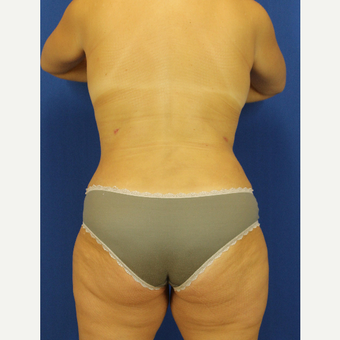 35-44 year old woman treated with Liposuction after 3748232