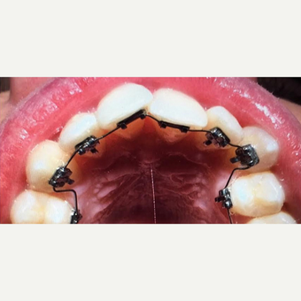 Lingual Braces before 3097309