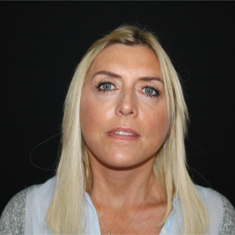 45-54 year old woman treated with Mini Lift after 3535462