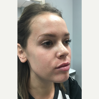 18-24 year old woman treated with Juvederm Volbella after 3769742