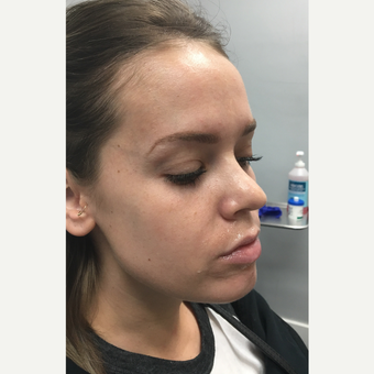 18-24 year old woman treated with Juvederm Volbella before 3769742