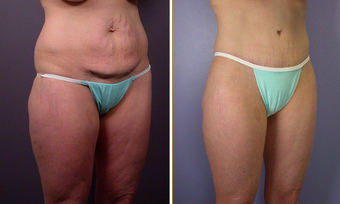 Tummy Tuck before 271079