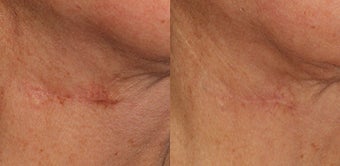 Laser Treatment for Scar Removal before 1317964