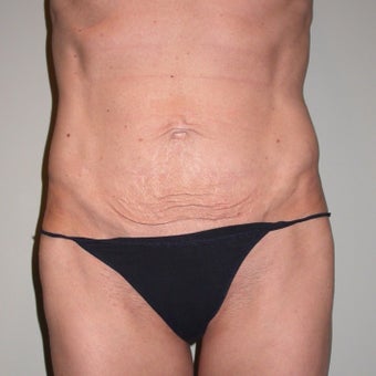 35-44 year old woman treated with Tummy Tuck before 1959780