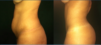 37 Year Old Female Tummy Tuck 1359161