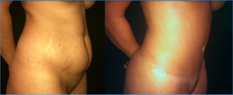 37 Year Old Female Tummy Tuck 1359161