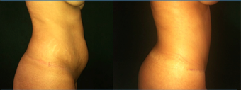37 Year Old Female Tummy Tuck after 1359161