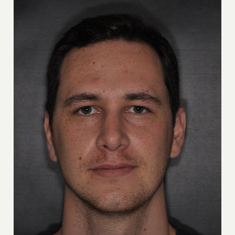 18-24 year old man treated with Rhinoplasty 6 weeks post-op after 3499607