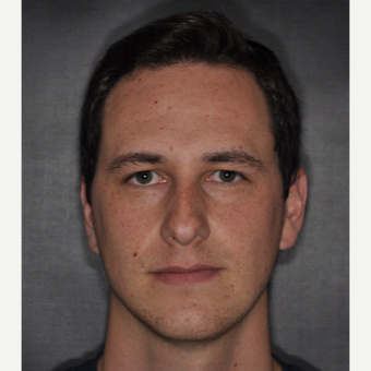 18-24 year old man treated with Rhinoplasty 6 weeks post-op before 3499607