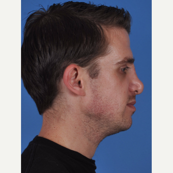 25-34 year old man treated with Revision Rhinoplasty before 3434521