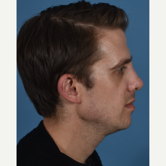 25-34 year old man treated with Revision Rhinoplasty after 3434521
