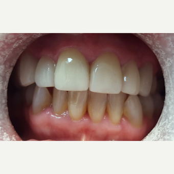 55-64 year old woman treated with Porcelain Veneers after 3197174