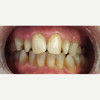 55-64 year old woman treated with Porcelain Veneers before 3197174
