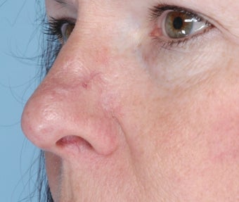 Lesion of the nose before 1105260