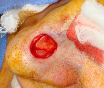 Lesion of the nose 1105260