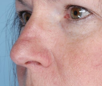Lesion of the nose after 1105260