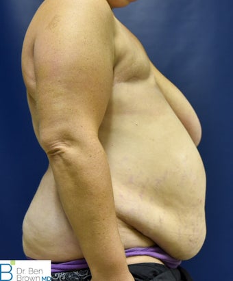 35-44 year old woman treated with Breast Reconstruction 3486734