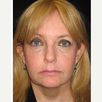 55-64 year old woman treated with Non Surgical Face Lift after 3181006