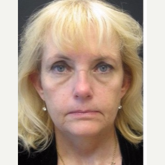 55-64 year old woman treated with Non Surgical Face Lift before 3181006