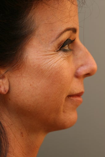 Female Chin Implant before 831900