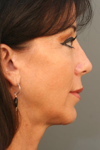 Female Chin Implant after 831900
