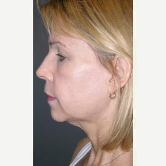 55-64 year old woman treated with Mini Lift before 3508672