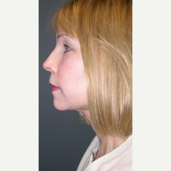 55-64 year old woman treated with Mini Lift after 3508672