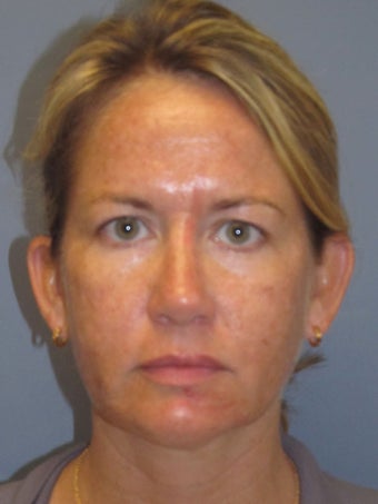 Chemical Peel - Blue Peel before 954436