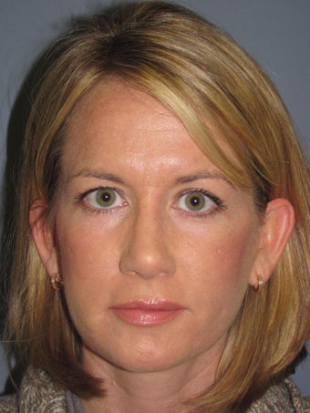 Chemical Peel - Blue Peel after 954436