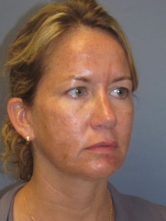 Chemical Peel - Blue Peel 954436