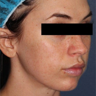 26 year old woman treated with IPL before 2073739