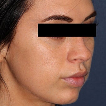 26 year old woman treated with IPL after 2073739