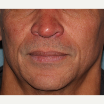 55-64 year old man treated with 2cc's Juvederm to deep lines around mouth after 3185522