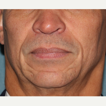 55-64 year old man treated with 2cc's Juvederm to deep lines around mouth before 3185522