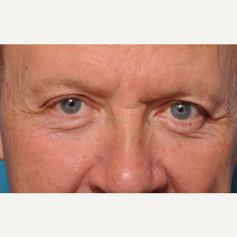 Transformation Eyelid Surgery after 3793645