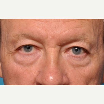 Transformation Eyelid Surgery before 3793645