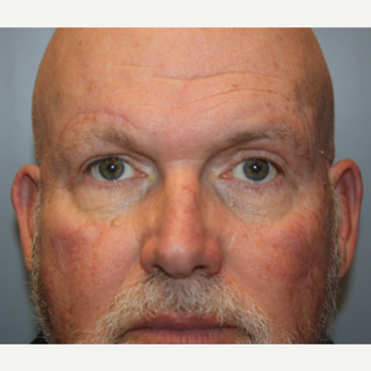 55-64 year old man treated with Brow Lift after 3708678