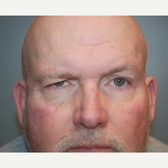 55-64 year old man treated with Brow Lift before 3708678