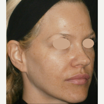 35-44 year old woman treated with IPL before 3125311